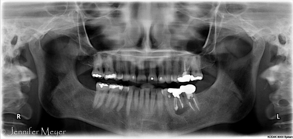 Evidence of an oversized crown on the bottom left.